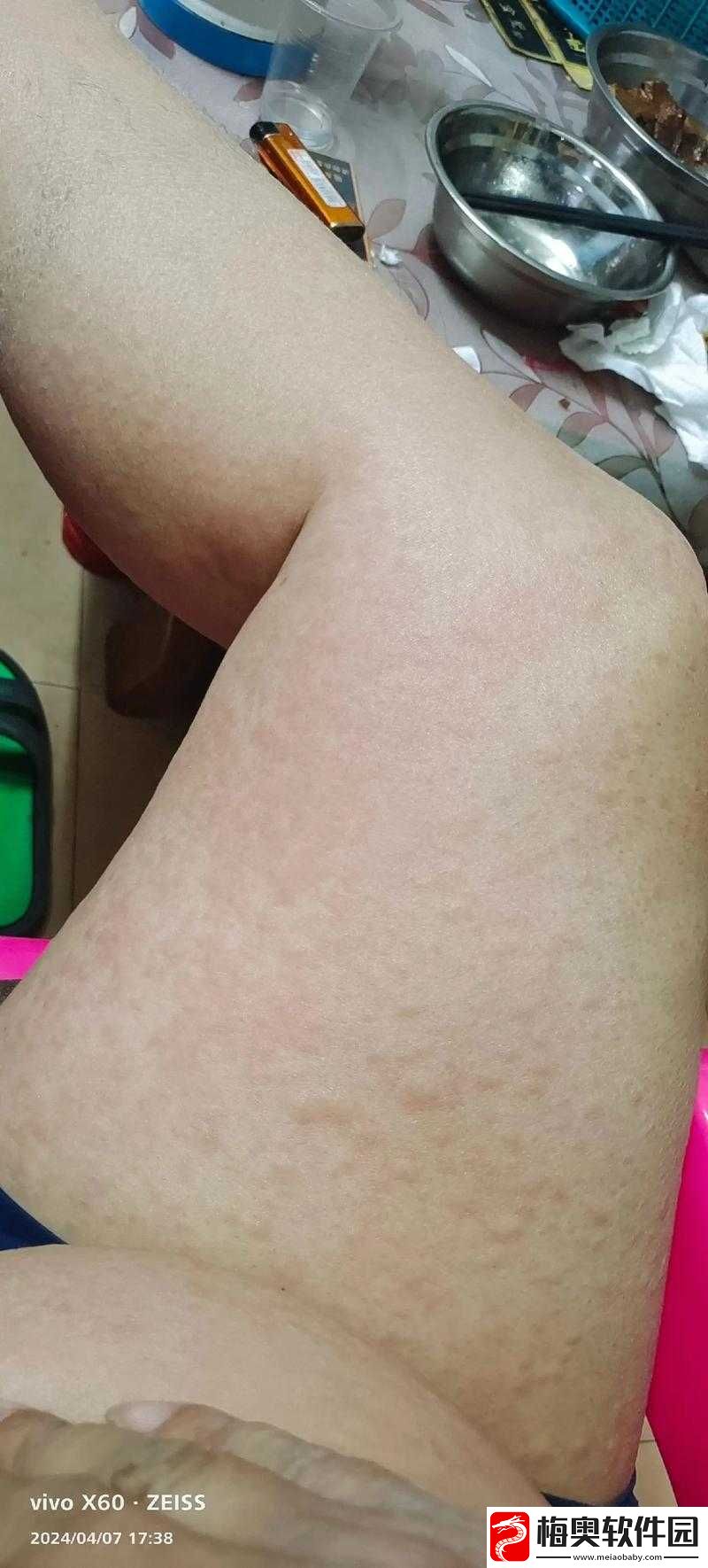 淑芳两腿间持续瘙痒达
