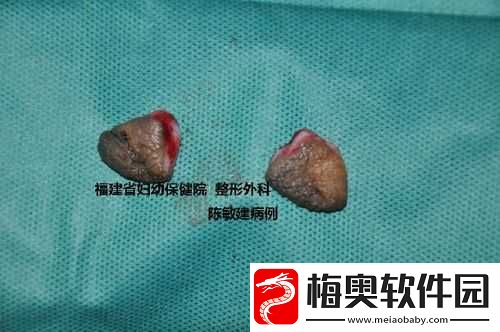 小阴天唇肥大整形有必要吗之探讨